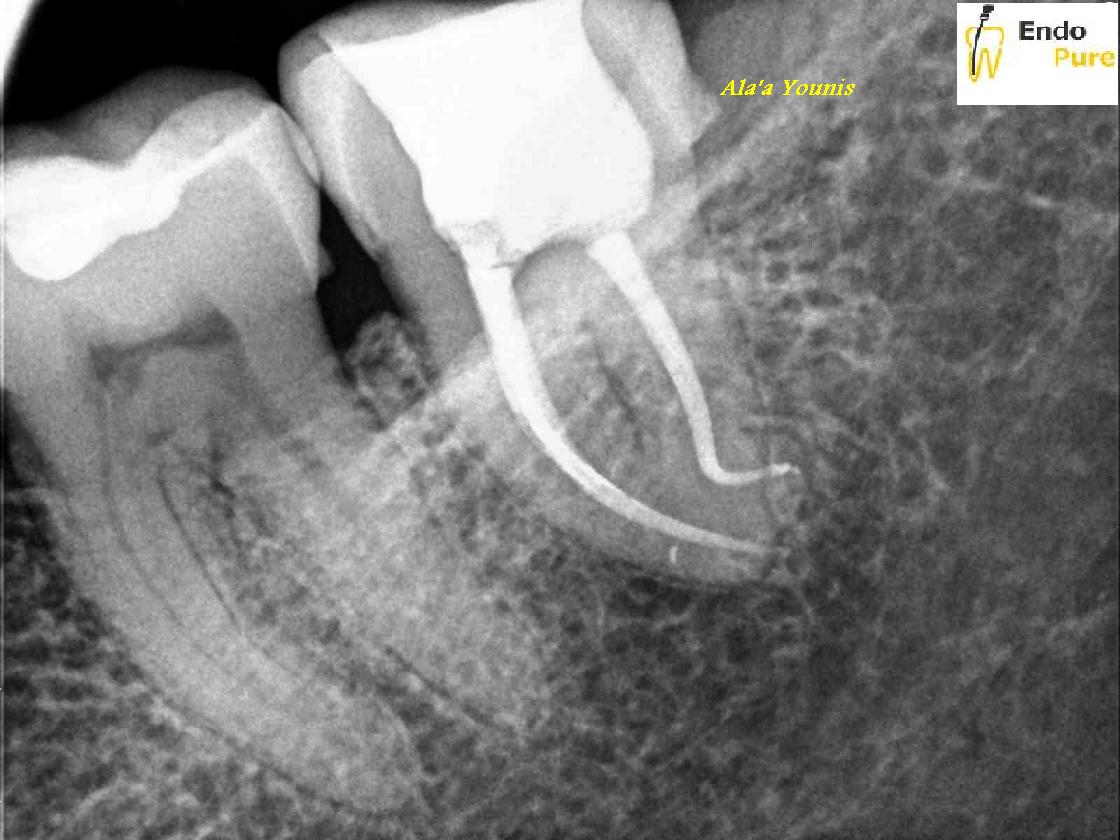 Management of curved canal/ Dr Ala’a younis Root canal specialist (Endodontist)